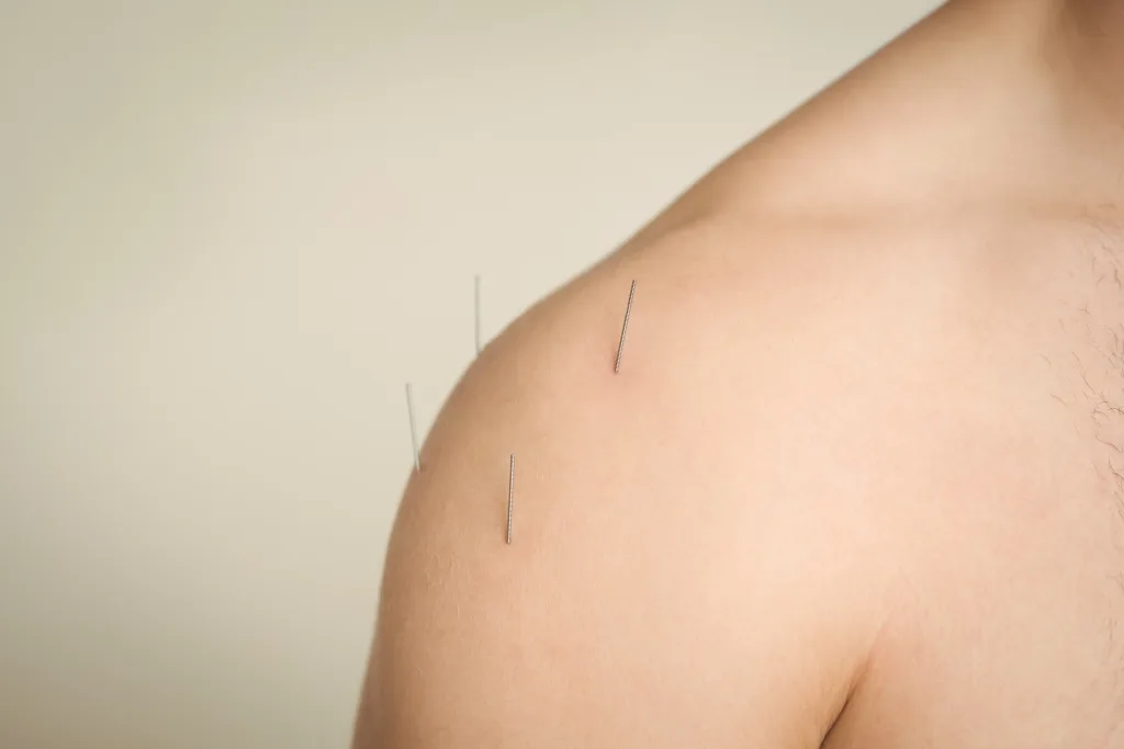 Acupuncture